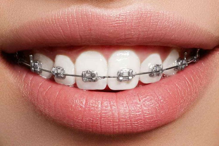 Are there any side effects of braces_ - Health Blogs