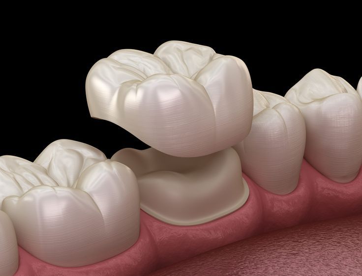 Do I Need a Porcelain Dental Crown _ Dental crown near me